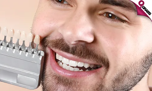 Hollywood Smile Veneers with Consultation!